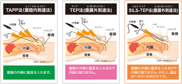 TAPP法、TEP法、SILS-TEP法の違い