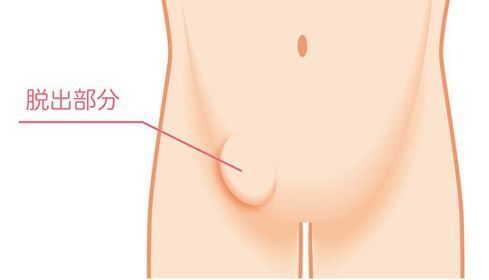 鼠経ヘルニア時の脱出部分