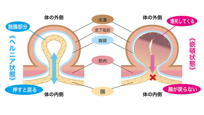 ヘルニア状態と嵌頓状態