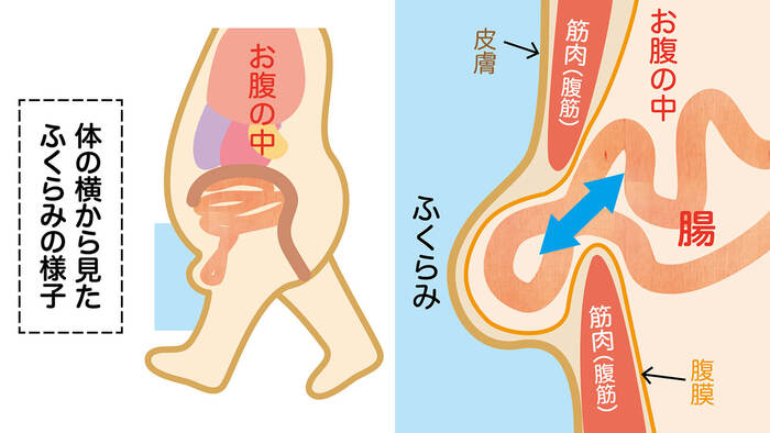 鼠径部が膨らんでいる様子