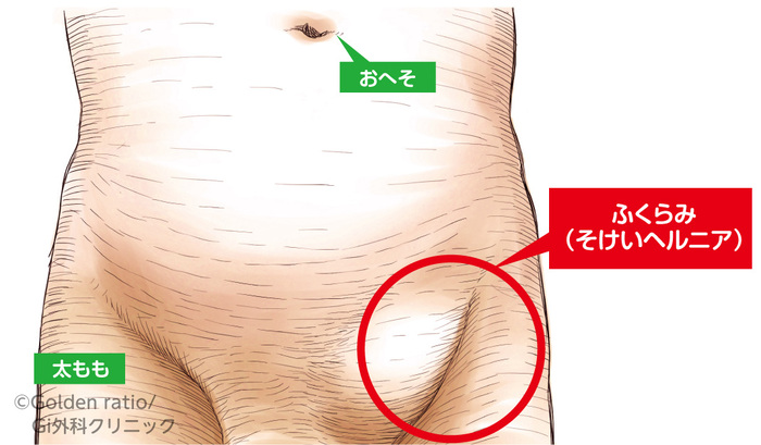 そけいヘルニア(脱腸)