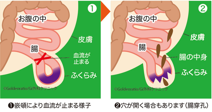 ヘルニア状態と嵌頓状態