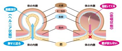 腸が押すと戻る鼠径ヘルニアの状態と、腸が戻らず壊死する嵌頓状態の違いを示す図