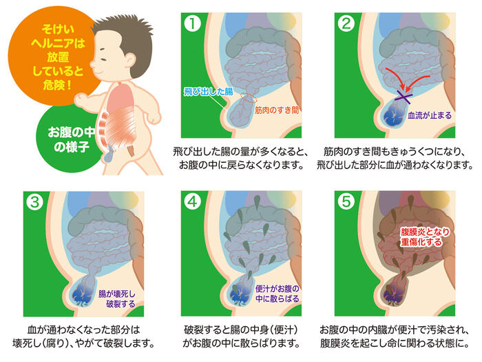 鼠径ヘルニア（脱腸）が発生する仕組みを段階的に示す　発生から嵌頓までイラスト
