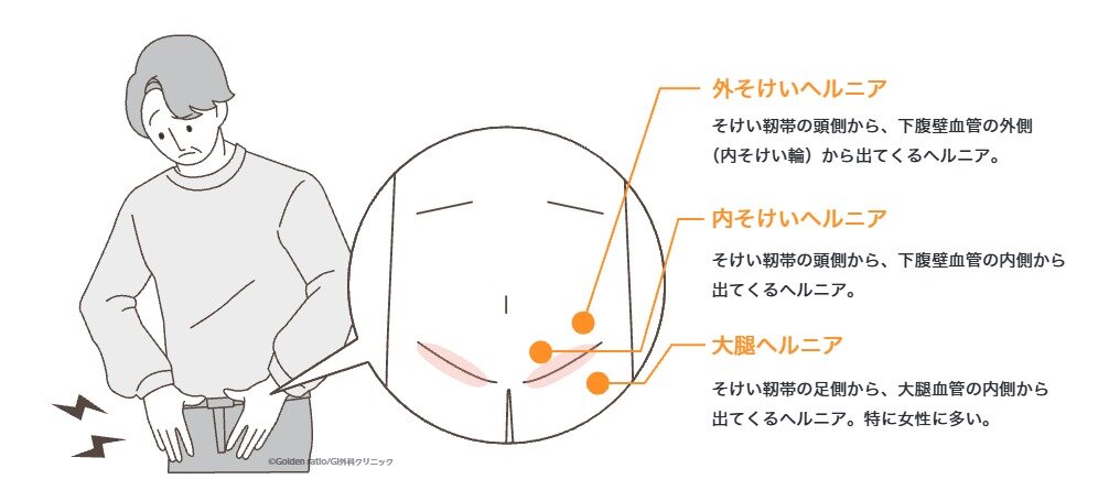 外鼠径ヘルニア・内鼠径ヘルニア・大腿ヘルニアの違いを説明するイラスト