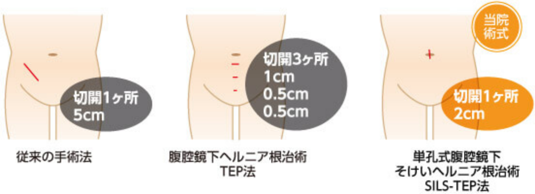 単孔式腹腔鏡下鼠径ヘルニア根治術(SILS-TEP法)の図説