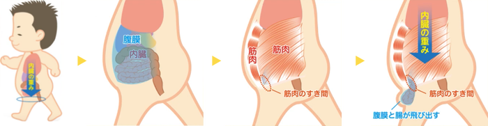 鼠経ヘルニアの説明