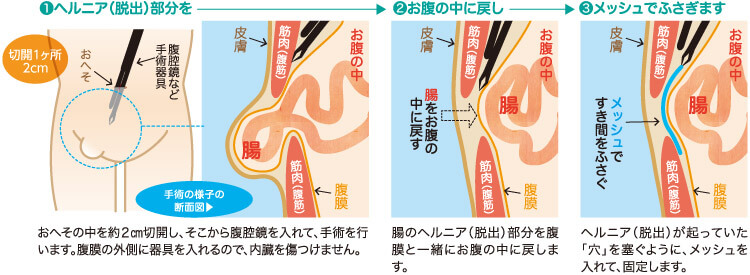 鼠径ヘルニア（脱腸）の手術｜お腹に入らない手術（SILS-TEP法）って