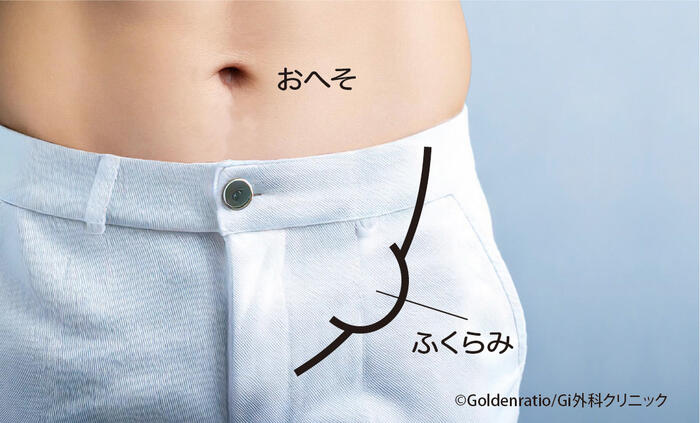 そけいヘルニア（脱腸）の見た目の例。写真ほど目立たなくても、鼠径部に違和感やふくらみが出る位置を示している