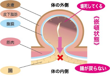 嵌頓状態の説明