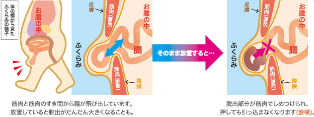 嵌頓状態の説明