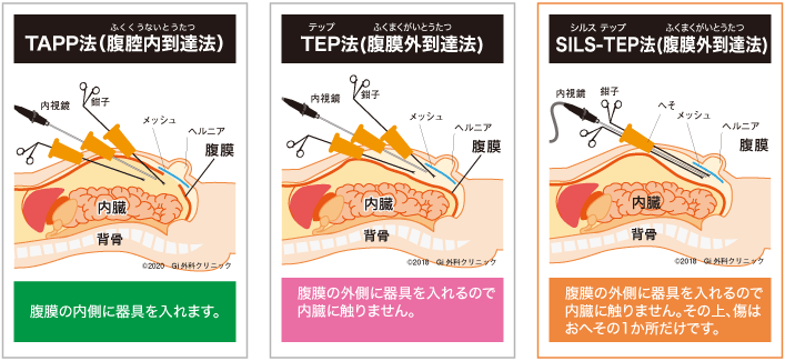 鼠径ヘルニアの治療とは？手術は必要？【専門医師が解説！】 - GI外科