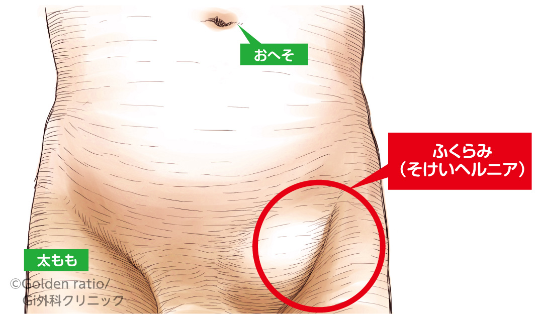 鼠径ヘルニアの治療とは？手術は必要？【専門医師が解説！】 - GI外科