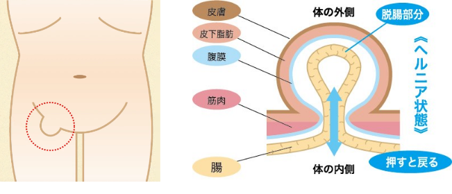 鼠径ヘルニア（脱腸）のふくらみの位置と腸が突出する仕組みを示す図